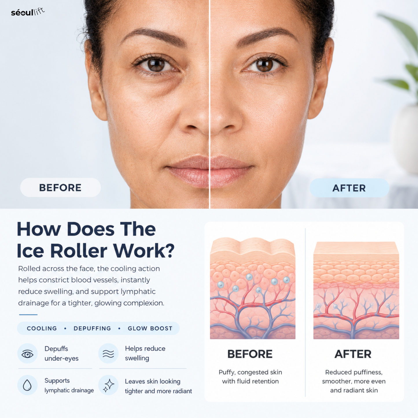 The CryoLift™ Ice Roller