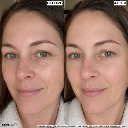 Hyaluronic Micro-Infusion Patches