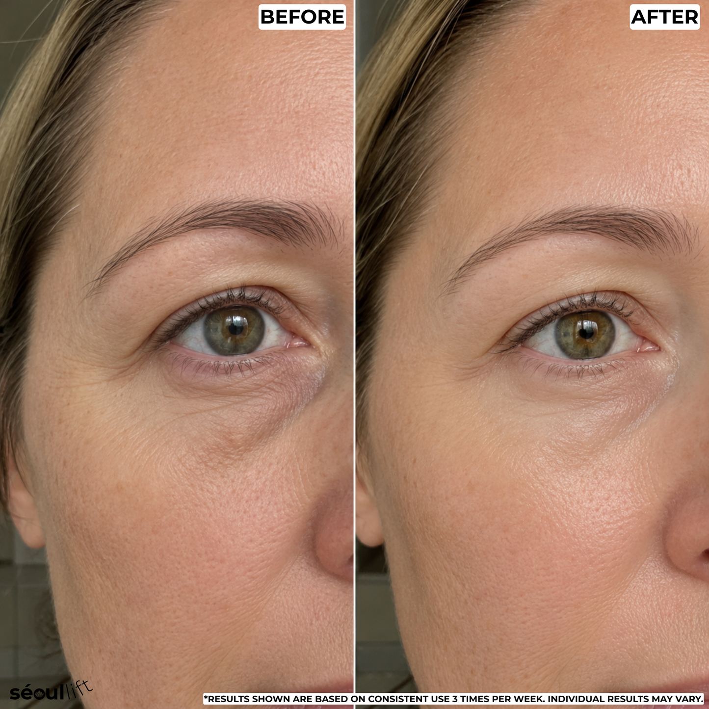 Hyaluronic Micro-Infusion Patches