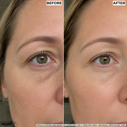 Hyaluronic Micro-Infusion Patches